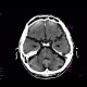 Brain contusion, subarachnoidal hematoma, beam hardening artifact: CT - Computed tomography